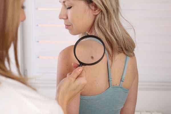 What Are Traditional Skin Lesion Removal Methods Wincanton?
