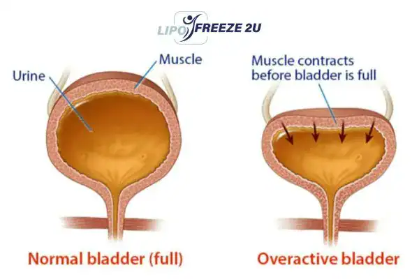 diagram of overactive bladder treatment Wincanton