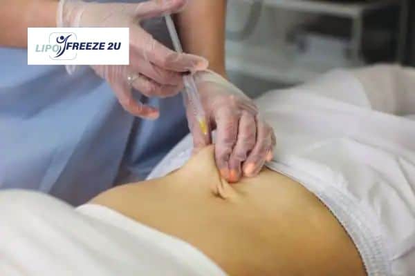 How Does Aqualyx Fat Dissolving Injection Work to Break Down Fat Wincanton?