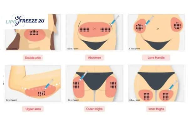 Benefits of Choosing Aqualyx for Fat Reduction Wincanton