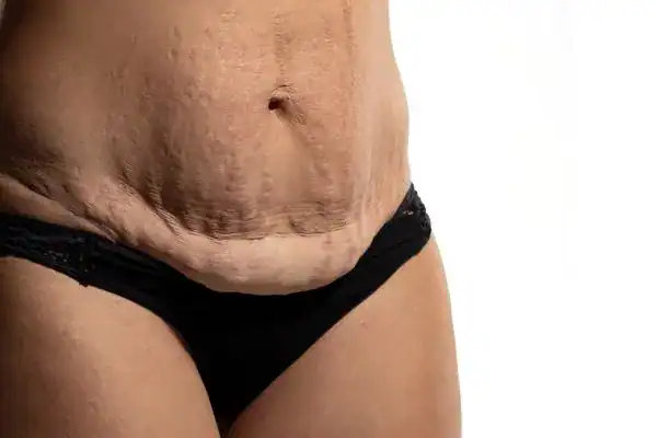 loose skin after weight loss injections Wincanton