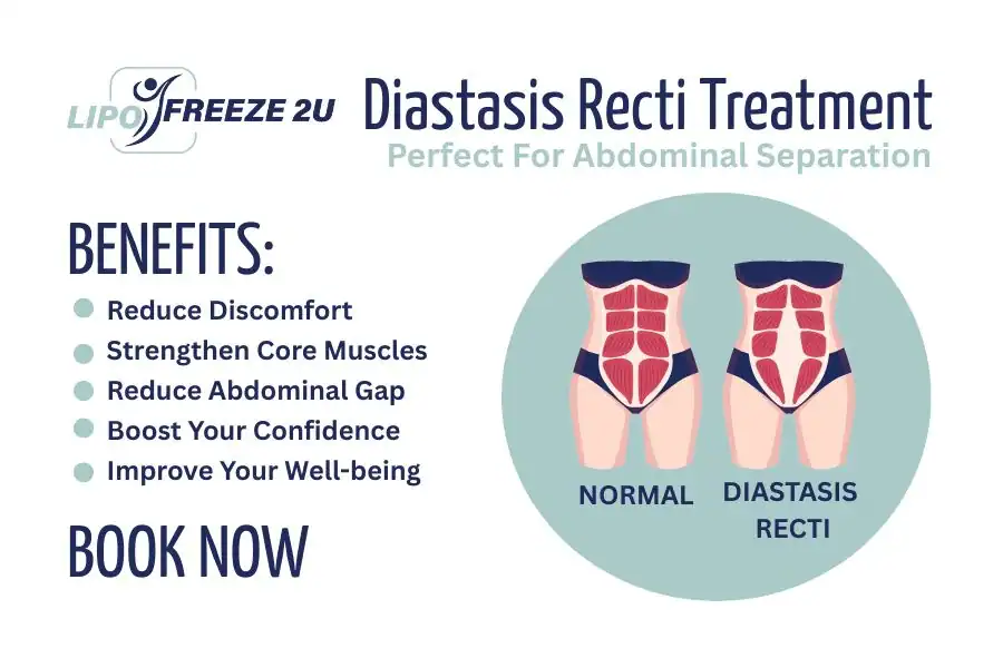 Benefits of body toning treatment Wincanton for Diastasis recti