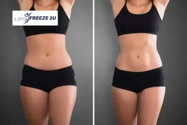 How Can LIPO FREEZE 2U Support Your Post-Pregnancy Body Recovery Wincanton?