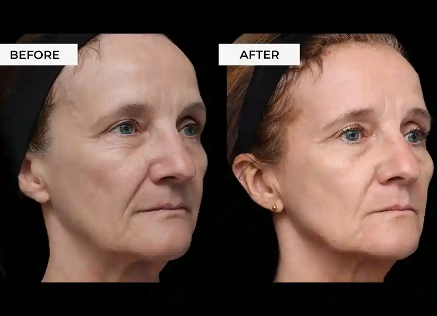 How Many RF Microneedling Sessions Will You Need to See a Difference Wincanton?