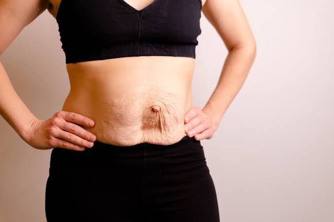 Is Surgery Really the Only Way to Repair Diastasis Recti Wincanton?