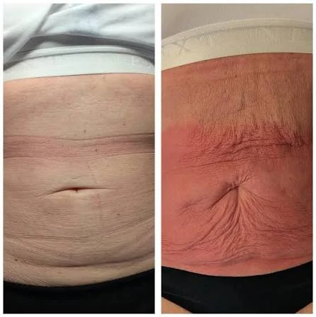 How Does RF Microneedling Improve Crepey, Thin and Uneven Skin Texture Wincanton?