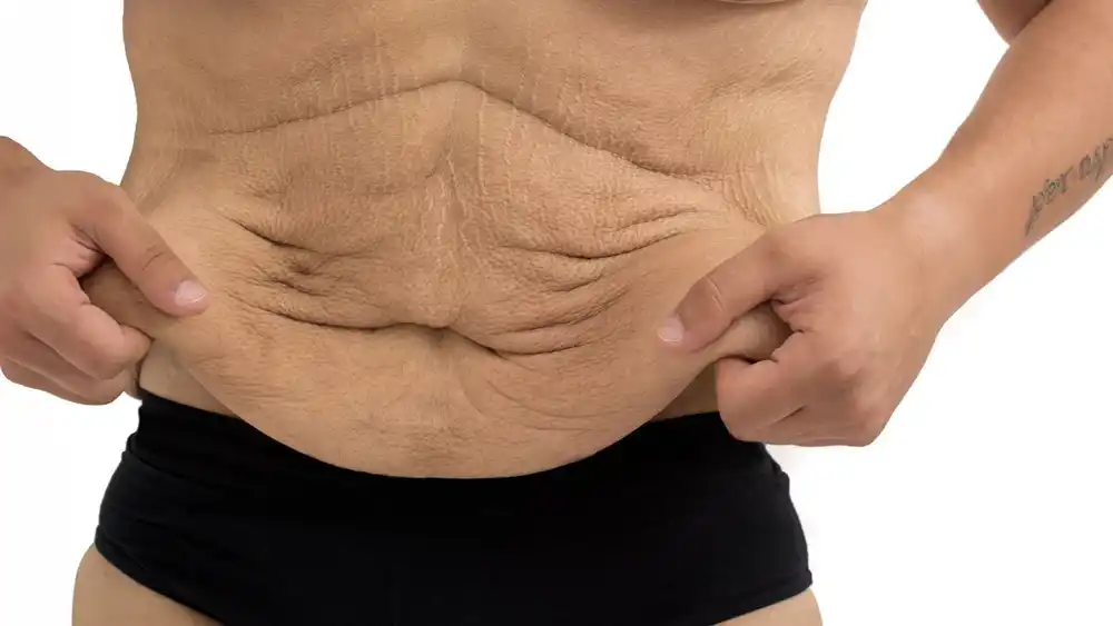 Why Does Weight Loss Medication Leave Some People With Loose or Sagging Skin Wincanton?